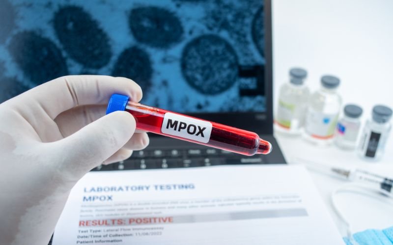 A new case of monkeypox registered in Sofia