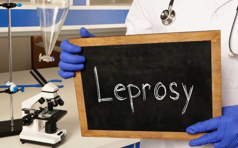 No Risk of Leprosy Spread in Bulgaria Following Cases in Croatia and Romania, Say Health Authorities