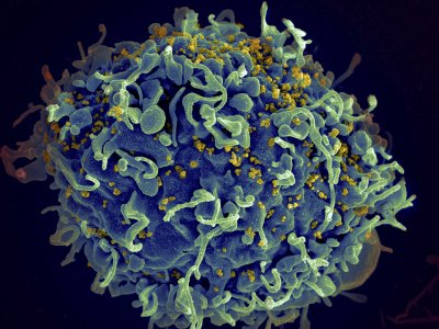 Изследователи са елиминирали ХИВ от клетки в лабораторни условия което