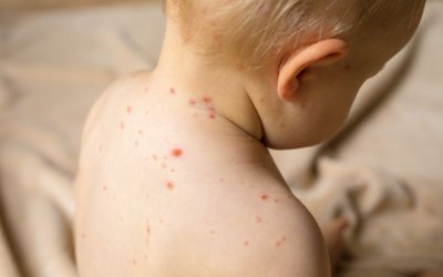 Ръст на случаите на варицела отчитат в Девин
