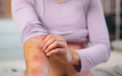 14 New Case of Measles Reported in First Days of April