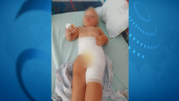 Дете е с химически изгаряния след посещение в столична ясла