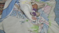 Бебето от Благоевград е получило фрактурата на крака дни преди установяването ѝ, твърдят медици